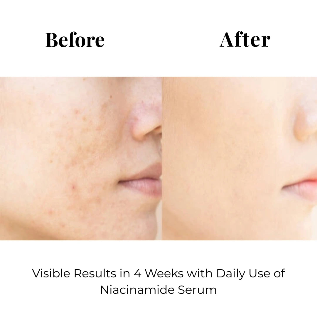 Before and after results showing improvement in skin texture and the appearance of pores